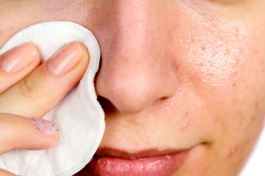 Blackhead Prevention for Students